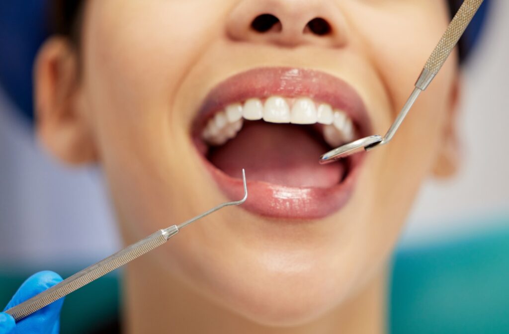 Close-up of a patient's open mouth during a dental cleaning.