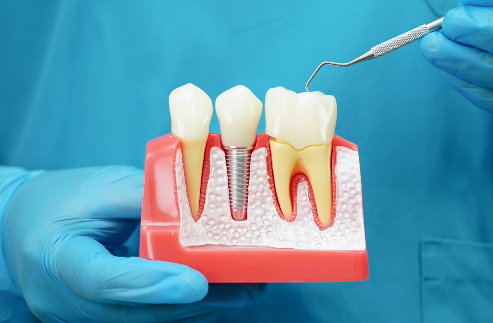 Close-up of a dental implant mock-up demonstrating the placement and structure.